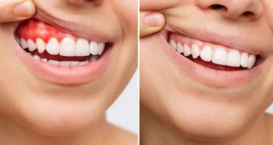 Periodoncia en Boadilla del Monte