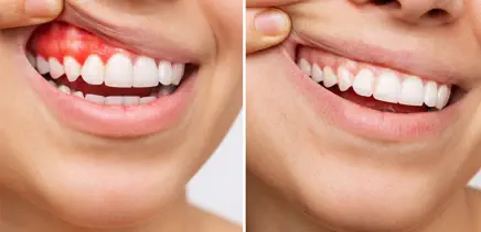 Periodoncia en Boadilla del Monte